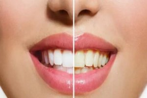 ترفندهایی جالب برای محافظت از دندان‌ها در برابر زردی